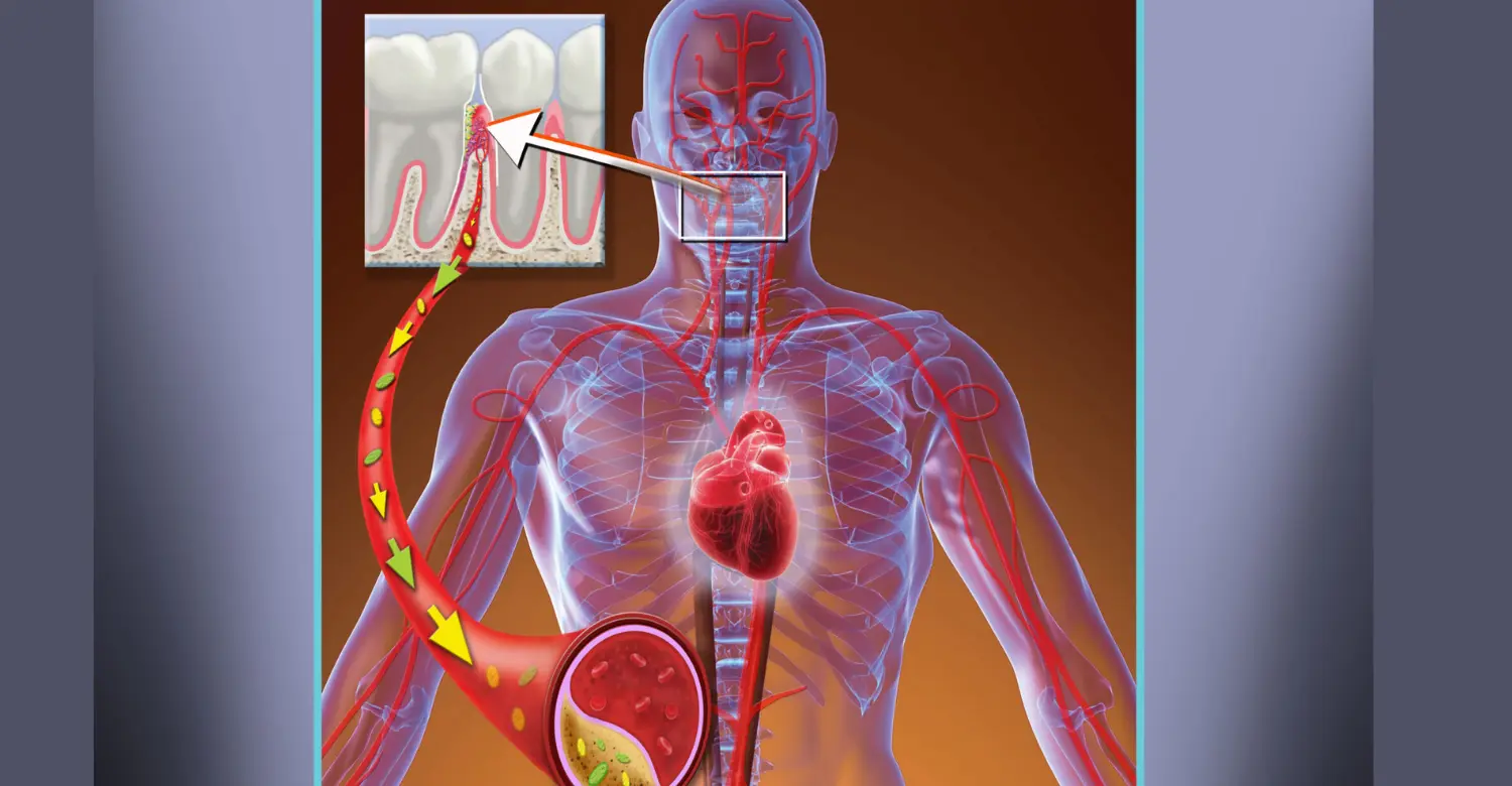 Can Periodontal Disease Cause Heart Problems 2